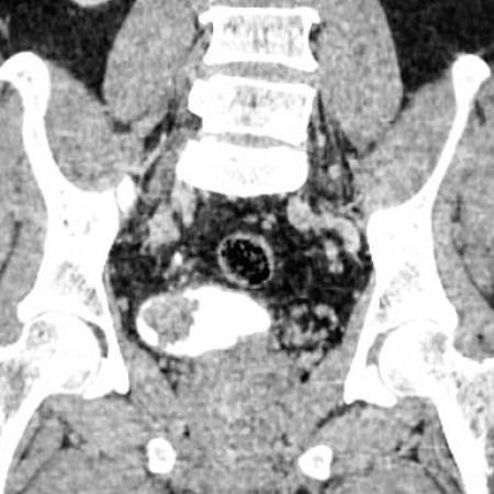 carcinoma of urinary bladder in coronal CT image.